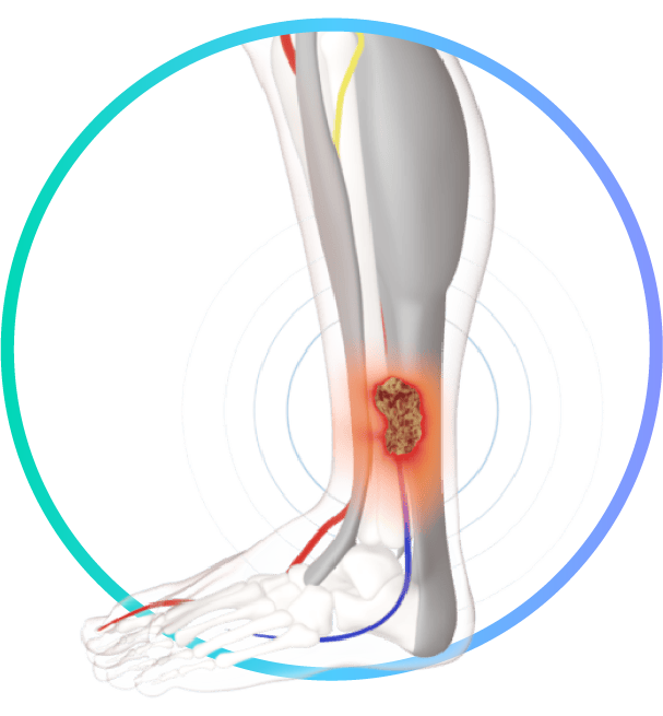 Accelerating chronic wound healing
