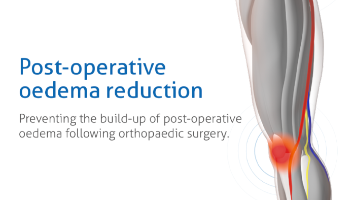 Firstkind Ltd geko® Post-operative oedema reduction brochure image Firstkind Ltd geko® Post-operative oedema reduction brochure