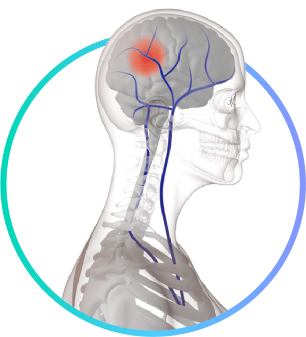 Preventing venous thromboembolism (VTE)